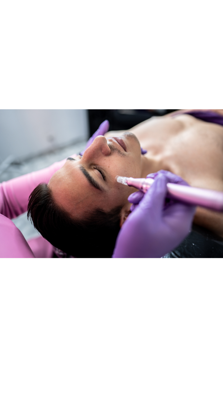 microneedling